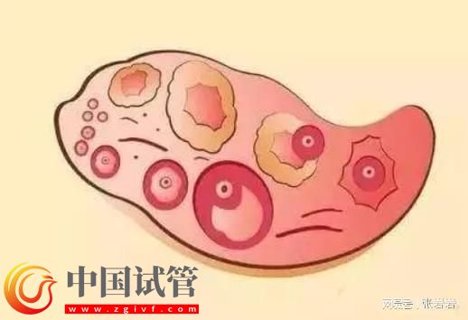 卵巢早衰卵泡不發(fā)育怎么辦？卵巢早衰可以借卵試管生孩子嗎？(圖7)