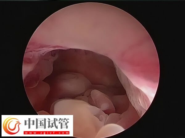 子宮內(nèi)膜息肉會不會影響試管嬰兒(圖1)