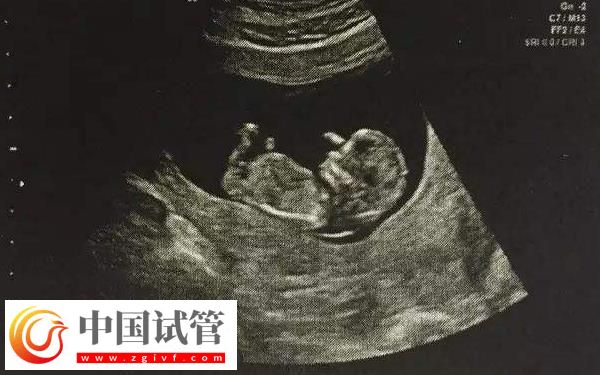 實(shí)施試管懷孕4個(gè)月穩(wěn)不穩(wěn)定(圖1)