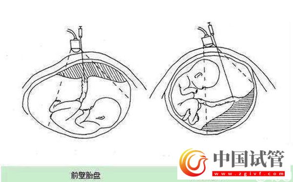 1分鐘了解胎盤前壁和后壁的3大區(qū)別，為孕期做好準(zhǔn)備(圖1)