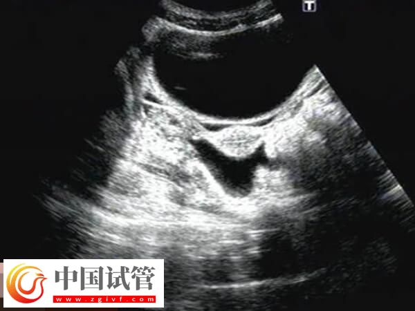 鮮胚移植后宮腔積液要注意，多久才能吸收一看便知(圖1)