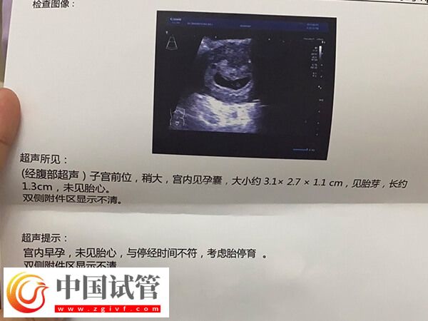 試管胎停育的前兆反應(yīng)有哪些(圖1)