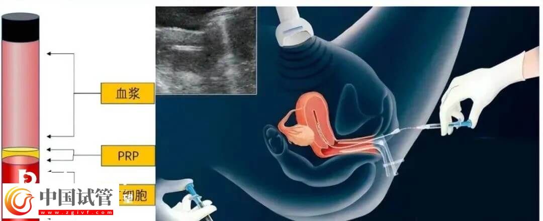 宮腔灌注具體的操作流程是怎么樣的？需要幾分鐘完成？(圖1)