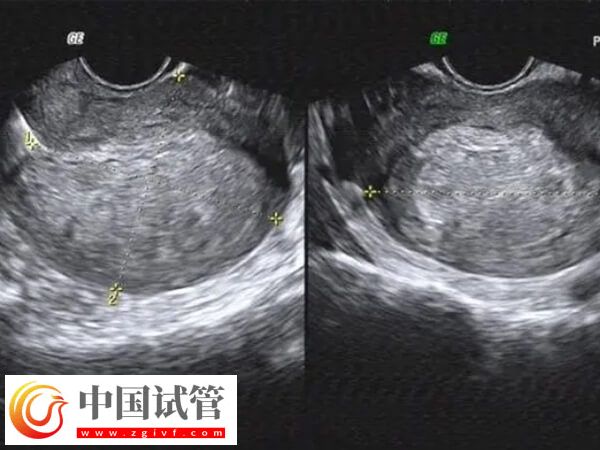 內(nèi)膜移植窗口期一共查幾次(圖2)