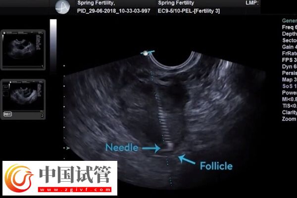 做試管嬰兒取卵后有腹水怎么辦(圖1) 做試管嬰兒取卵后有腹水怎么辦(圖1)