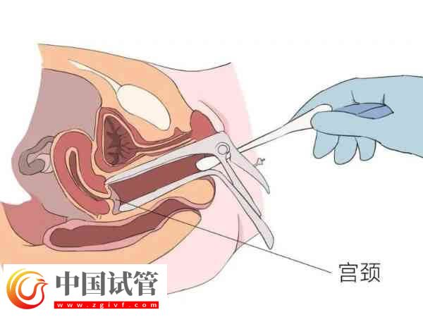 宮腔粘連是怎么引起的(圖1) 宮腔粘連是怎么引起的(圖1)