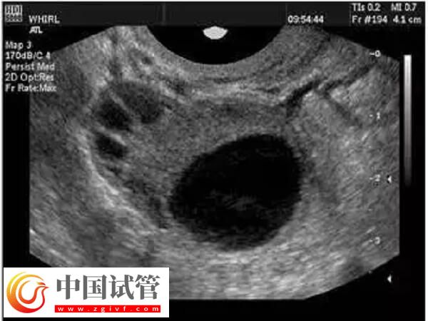 取卵為什么出現(xiàn)異形卵子(圖1) 取卵為什么出現(xiàn)異形卵子(圖1)